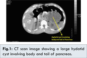 pancreatic hydatid cyst ct